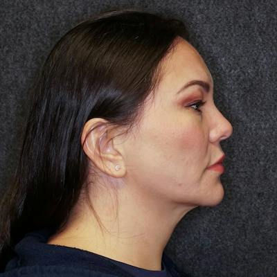 Deep Neck Lift Before & After Gallery - Patient 369523 - Image 1