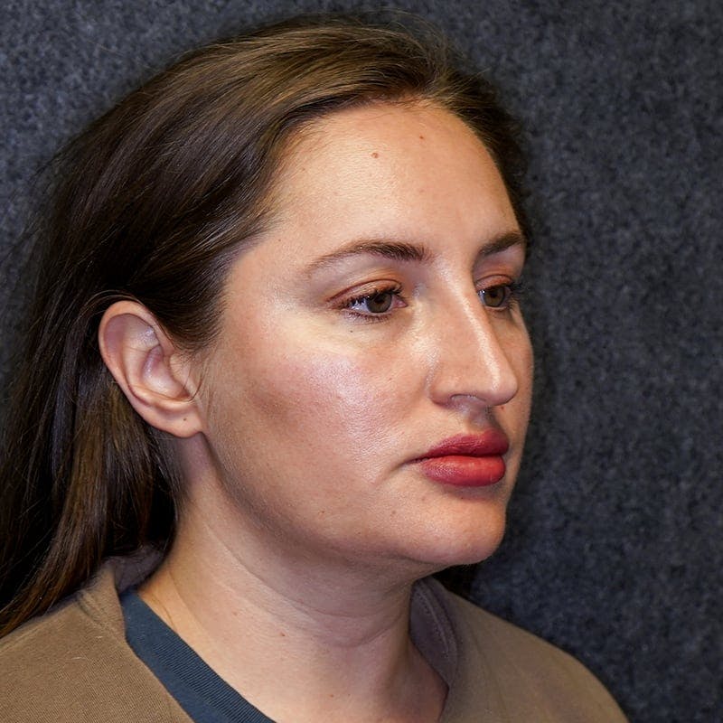 neck liposuction before & after