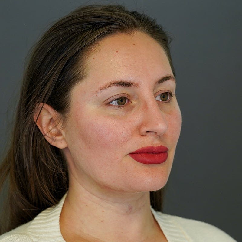 neck liposuction before & after