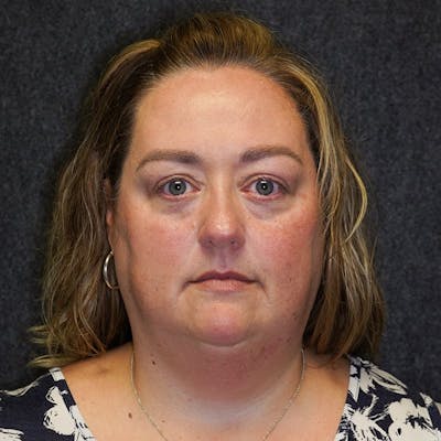 Blepharoplasty Before & After Gallery - Patient 320434 - Image 1
