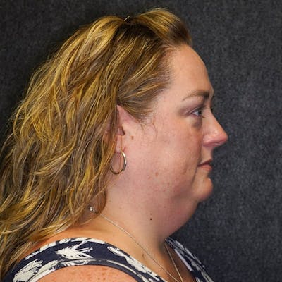 Deep Plane Facelift Before & After Gallery - Patient 353415 - Image 1