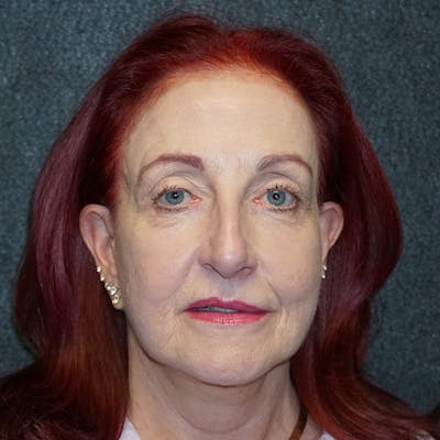 Brow Lift Before & After Gallery - Patient 311188 - Image 1
