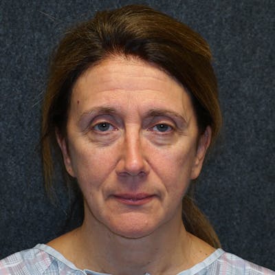 Blepharoplasty Before & After Gallery - Patient 230991 - Image 1