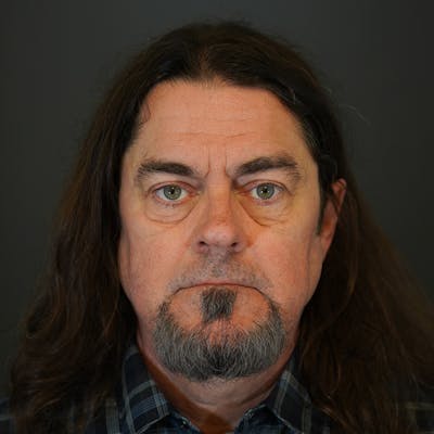 Blepharoplasty Before & After Gallery - Patient 222686 - Image 1