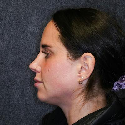 Deep Neck Lift Before & After Gallery - Patient 183052 - Image 1
