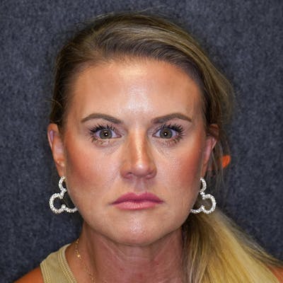 Brow Lift Before & After Gallery - Patient 331620 - Image 1