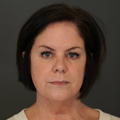 Blepharoplasty Before & After Gallery - Patient 402071 - Image 1