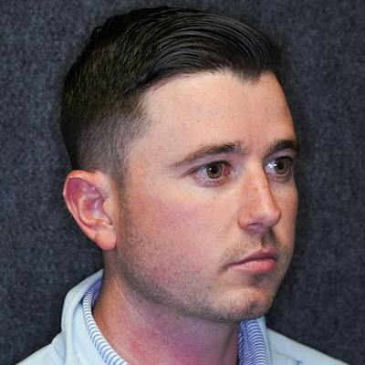 Male Rhinoplasty Before & After Gallery - Patient 382834 - Image 1