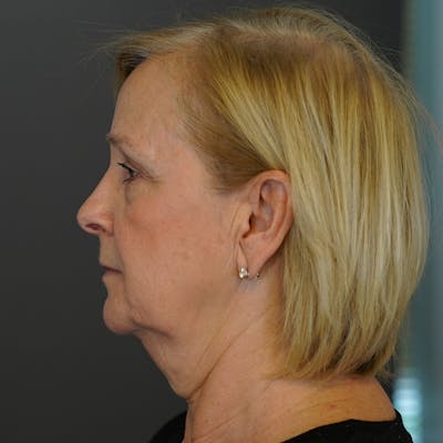 Deep Plane Facelift Before & After Gallery - Patient 237331 - Image 1