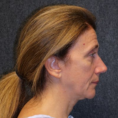 Deep Plane Facelift Before & After Gallery - Patient 311227 - Image 1