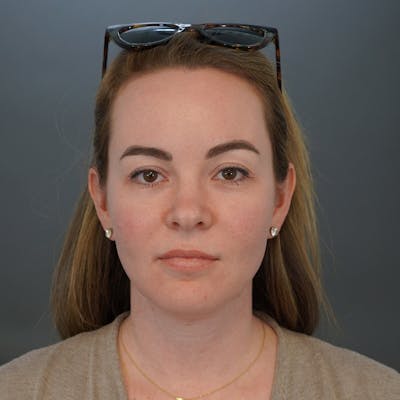 Brow Lift Before & After Gallery - Patient 445927 - Image 1