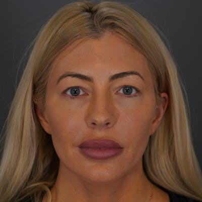 Blepharoplasty Before & After Gallery - Patient 305841 - Image 1