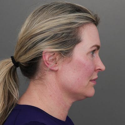 Deep Plane Facelift Before & After Gallery - Patient 372506 - Image 1
