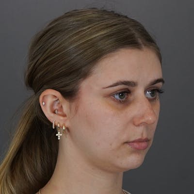 Chin Augmentation Before & After Gallery - Patient 341005 - Image 1