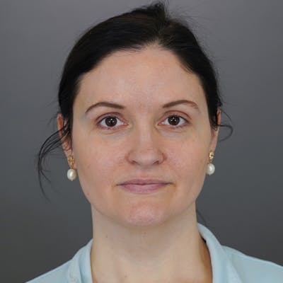Brow Lift Before & After Gallery - Patient 400905 - Image 1