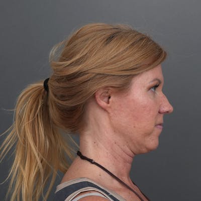 Deep Plane Facelift Before & After Gallery - Patient 328992 - Image 1