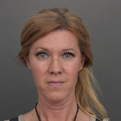 Brow Lift Before & After Gallery - Patient 366810 - Image 1