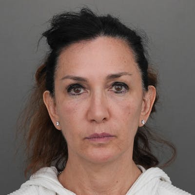 Brow Lift Before & After Gallery - Patient 220945 - Image 1