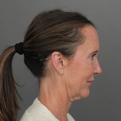 Deep Plane Facelift Before & After Gallery - Patient 343781 - Image 1