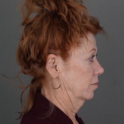 Deep Plane Facelift Before & After Gallery - Patient 306835 - Image 1