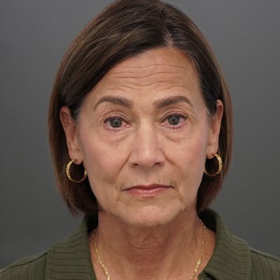 Blepharoplasty Before & After Gallery - Patient 325561 - Image 1