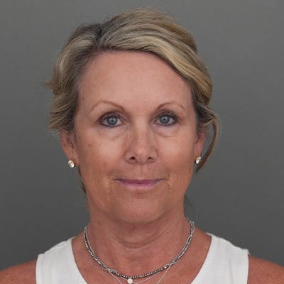 Blepharoplasty Before & After Gallery - Patient 265337 - Image 1