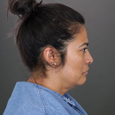 Deep Plane Facelift Before & After Gallery - Patient 835219 - Image 1