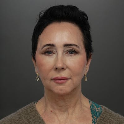 Brow Lift Before & After Gallery - Patient 410004 - Image 1