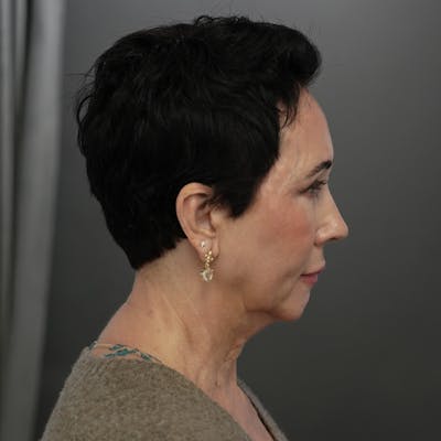 Deep Plane Facelift Before & After Gallery - Patient 257010 - Image 1