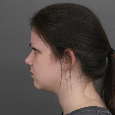 Deep Neck Lift Before & After Gallery - Patient 137090 - Image 1