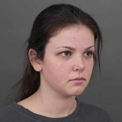 Chin Augmentation Before & After Gallery - Patient 328365 - Image 1