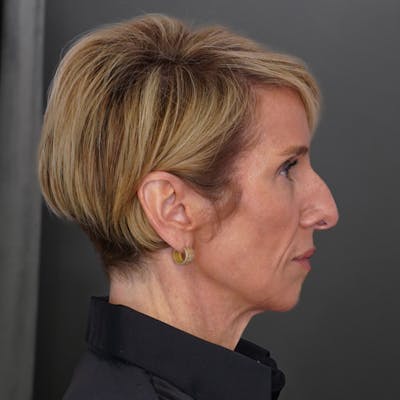 Deep Plane Facelift Before & After Gallery - Patient 189484 - Image 1
