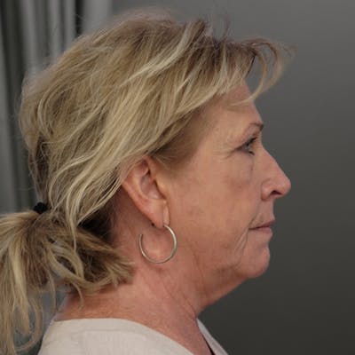 Blepharoplasty Before & After Gallery - Patient 356471 - Image 1