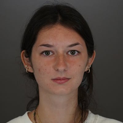 Blepharoplasty Before & After Gallery - Patient 104139 - Image 1