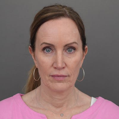 Blepharoplasty Before & After Gallery - Patient 194018 - Image 1