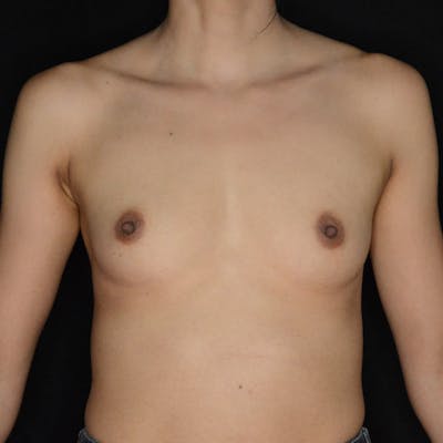 Breast Augmentation Before & After Gallery - Patient 300291 - Image 1