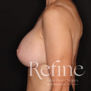 Breast Augmentation with Lift Before & After Gallery - Patient 314624 - Image 10