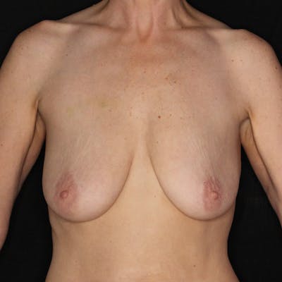 Breast Augmentation with Lift Before & After Gallery - Patient 314624 - Image 1