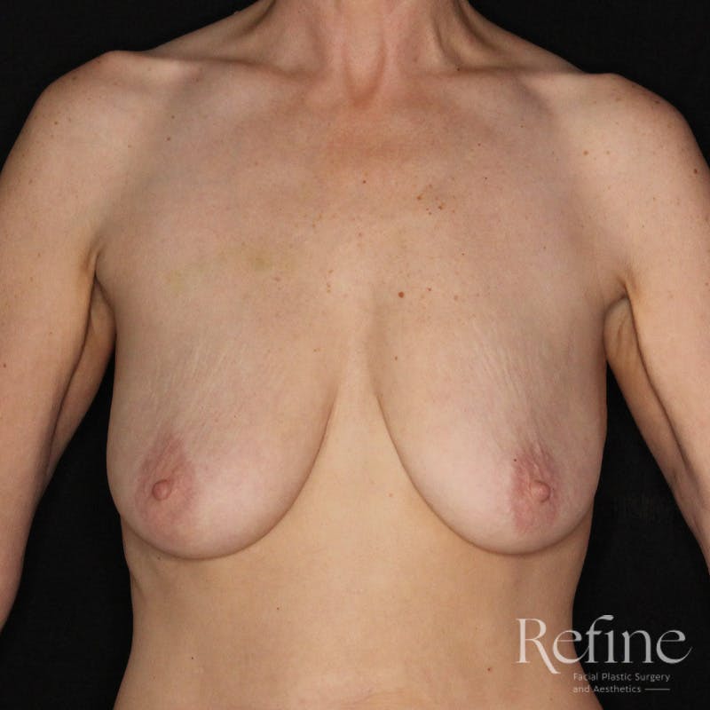 Breast Augmentation with Lift Before & After Gallery - Patient 314624 - Image 1