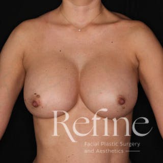 Breast Augmentation Before & After Gallery - Patient 314081 - Image 2