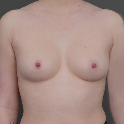 Breast Augmentation Before & After Gallery - Patient 197808 - Image 1
