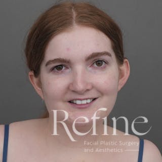 Chin Augmentation Before & After Gallery - Patient 142922 - Image 6