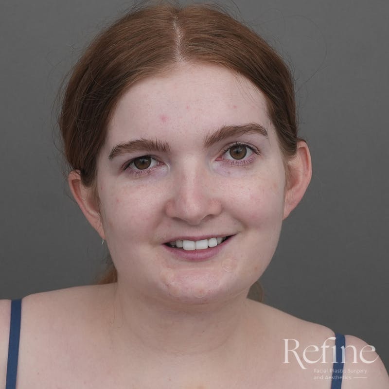 Chin Augmentation Before & After Gallery - Patient 142922 - Image 6