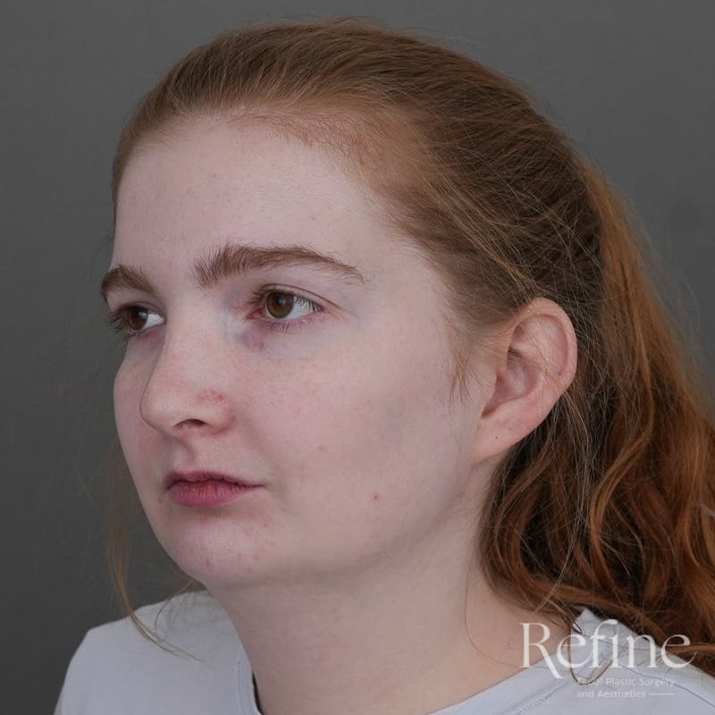 Chin Augmentation Before & After Gallery - Patient 142922 - Image 7