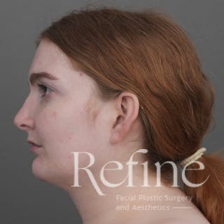 Chin Augmentation Before & After Gallery - Patient 142922 - Image 10