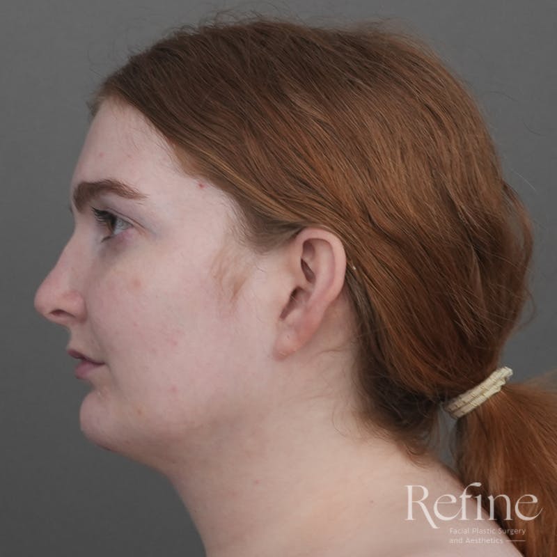Chin Augmentation Before & After Gallery - Patient 142922 - Image 10