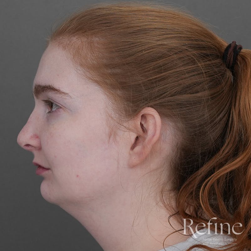 Chin Augmentation Before & After Gallery - Patient 142922 - Image 9