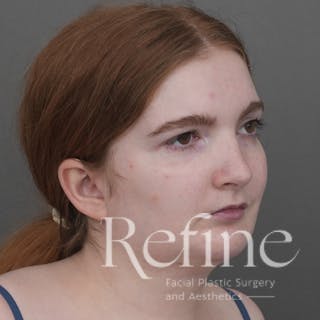 Chin Augmentation Before & After Gallery - Patient 142922 - Image 2