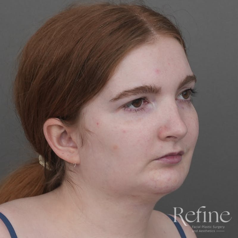Chin Augmentation Before & After Gallery - Patient 142922 - Image 2