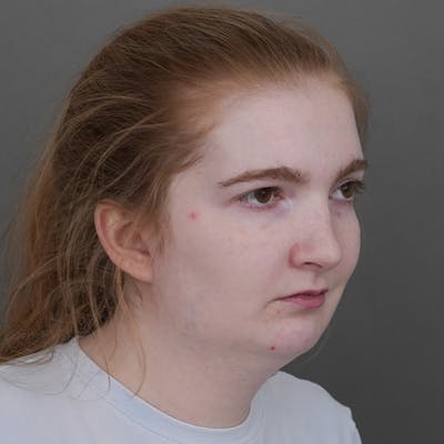 Chin Augmentation Before & After Gallery - Patient 142922 - Image 1